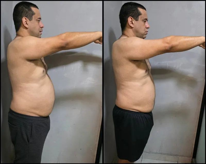 Antes e depois de paciente do Pedro Dias